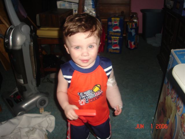 Thomas broken arm 2