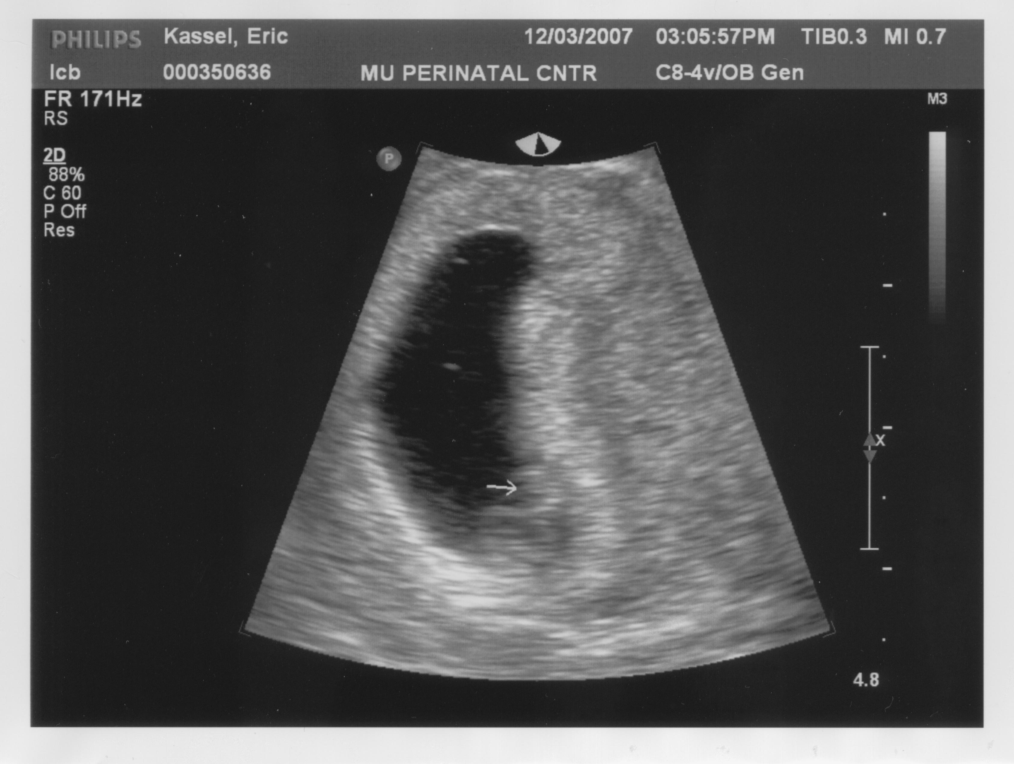 Sonogram1