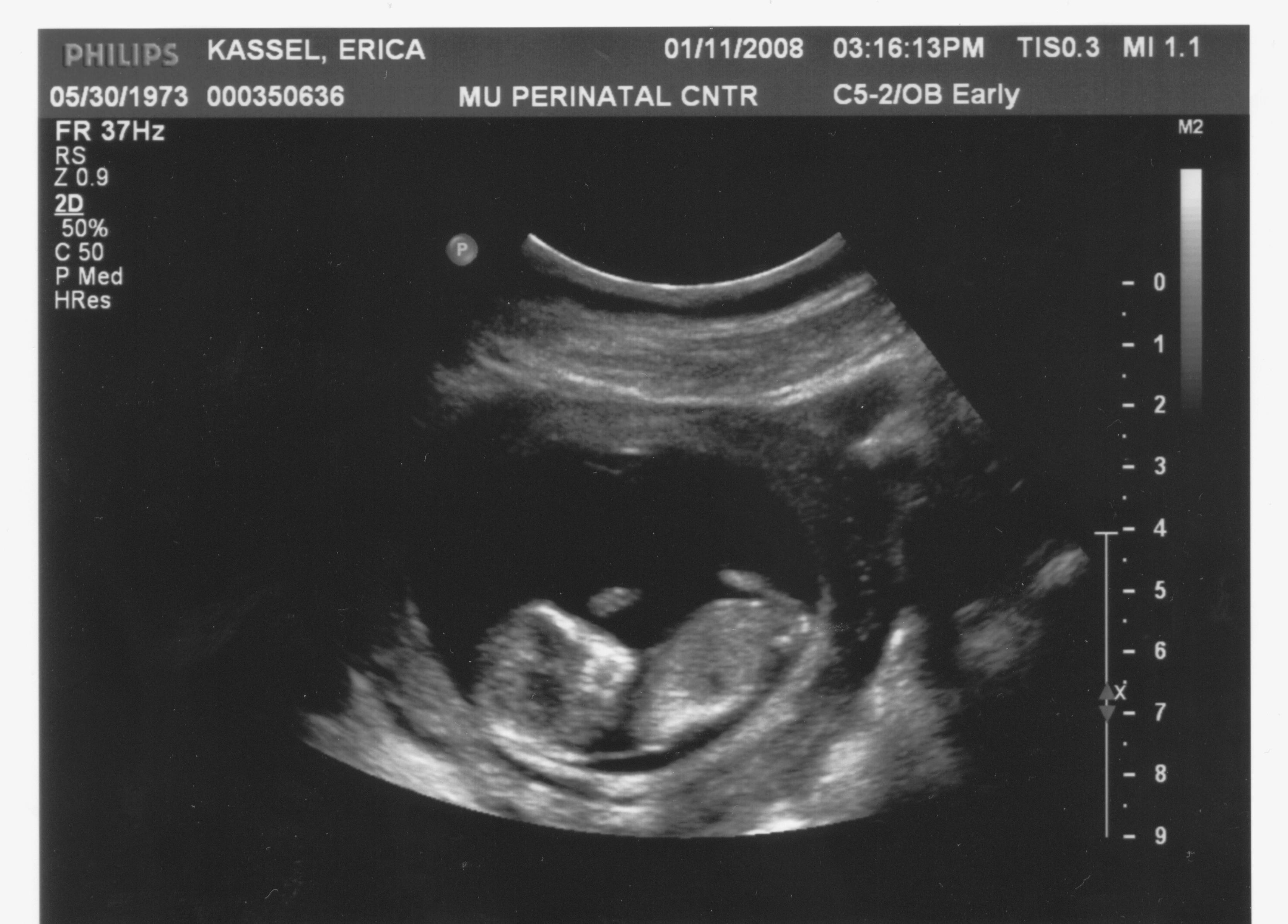 Ultrasound2 3