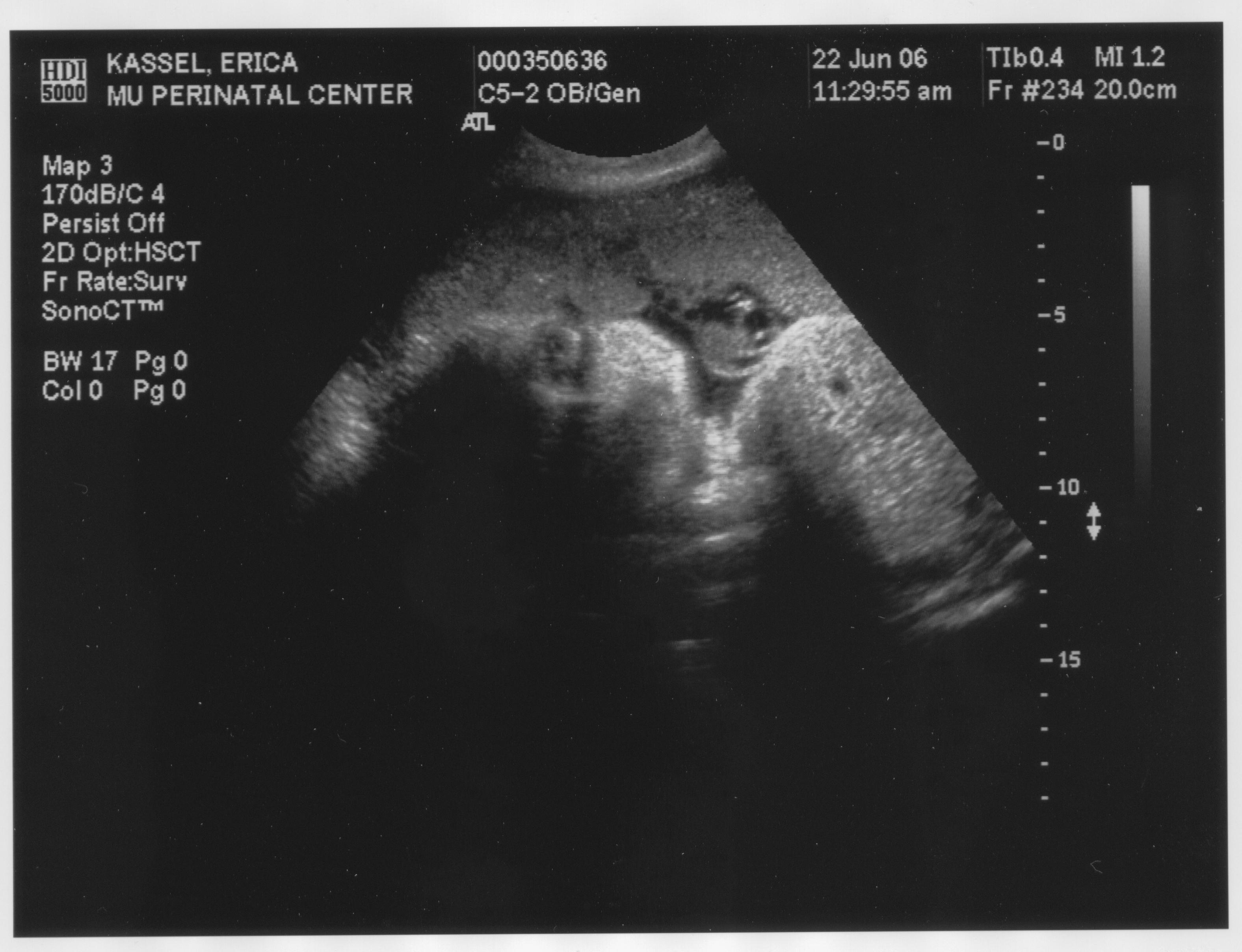 Second Ultrasound