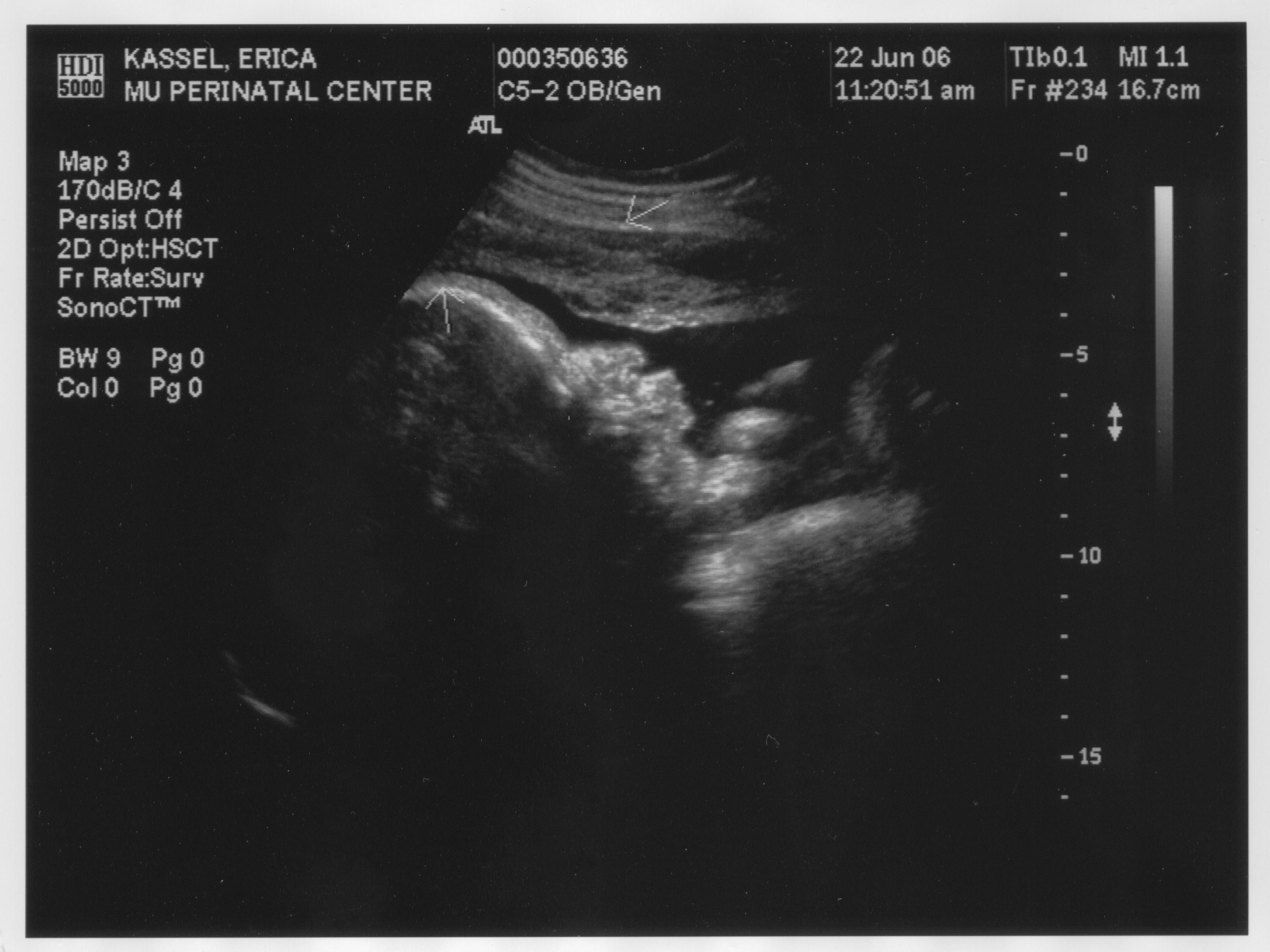 Ultrasound2 3